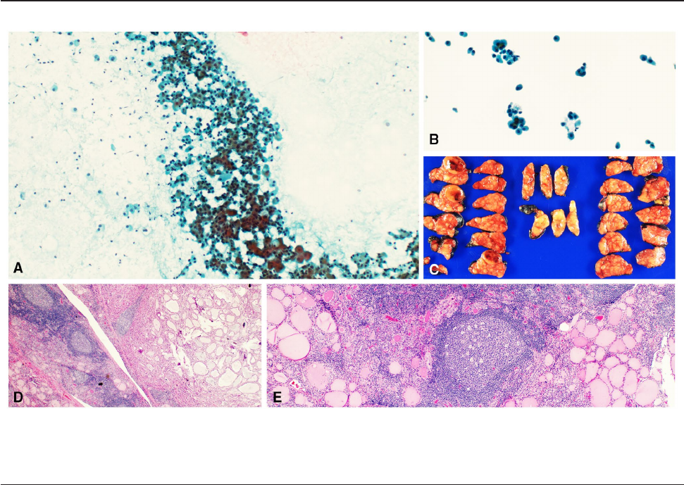 Molecular alterations in Hürthle cell neoplasms of thyroid: A fine needle aspiration cytology study with cytology‐histology correlation