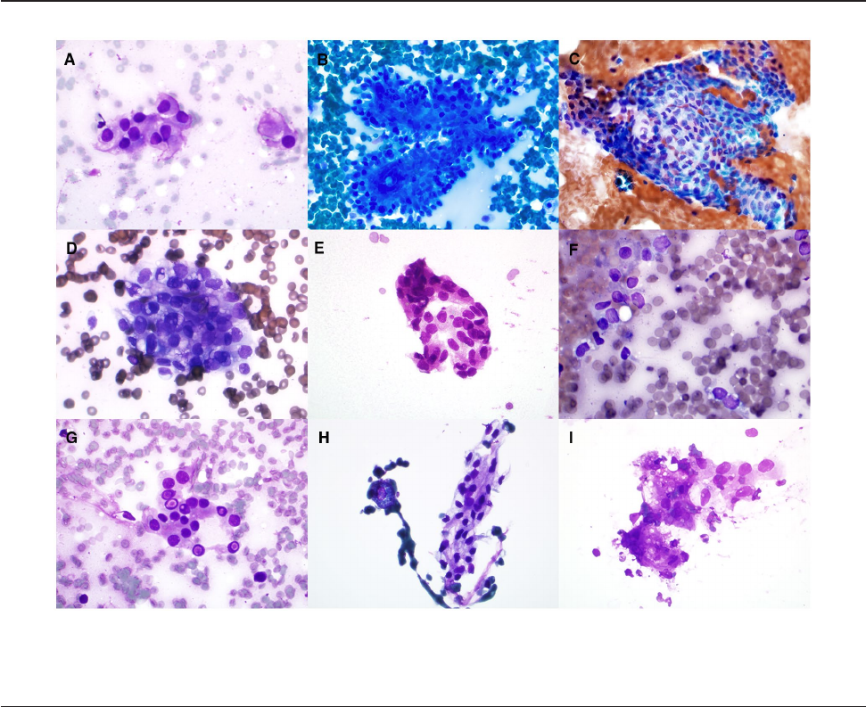 Cytomorphologic analysis of clear cell papillary renal cell carcinoma: Distinguishing diagnostic features